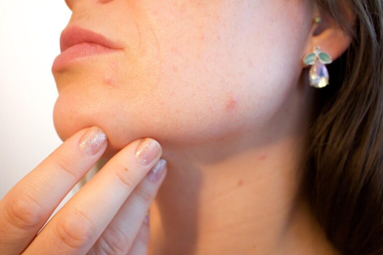Private Dermatology in Portsmouth - Fast Access for Rashes; Acne and Mole Checks